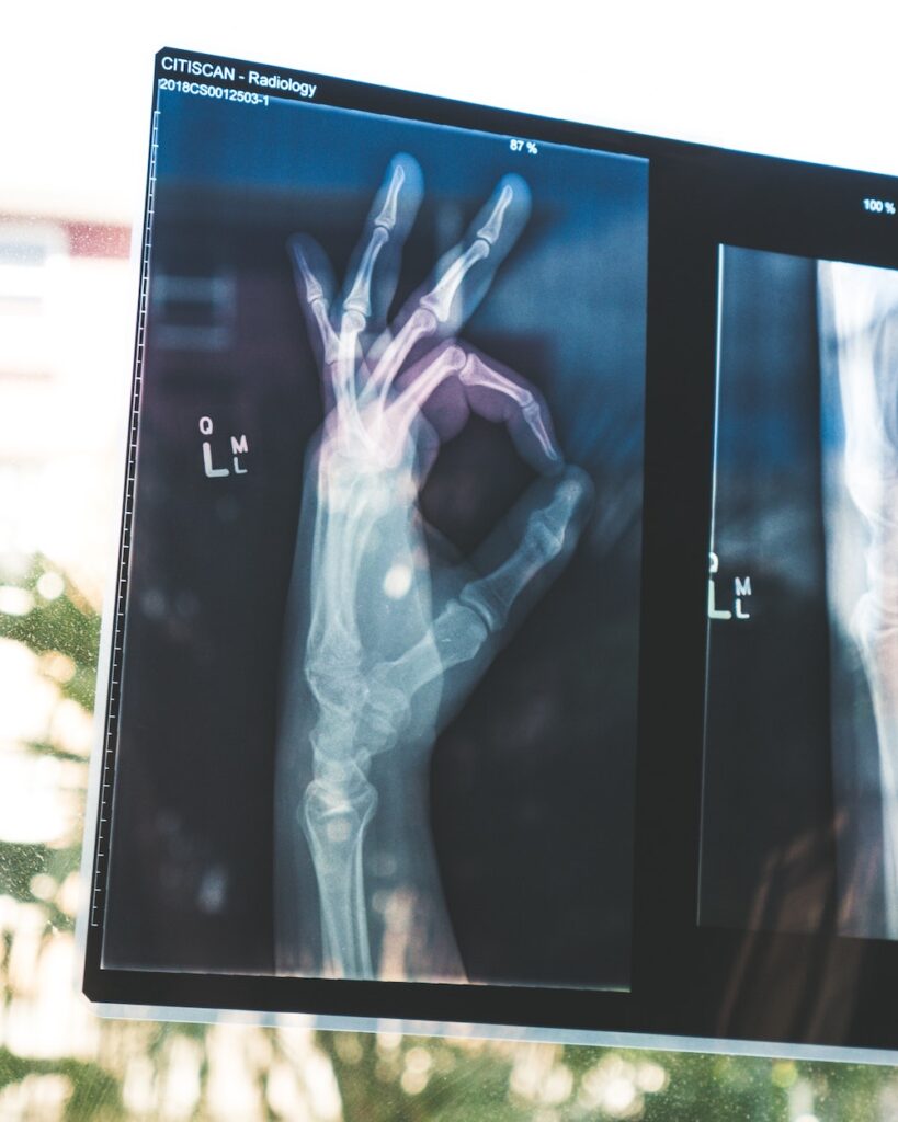 x-ray of a hand making the "okay" sign as a way of saying both official and unofficial diagnosis for autism are fine.